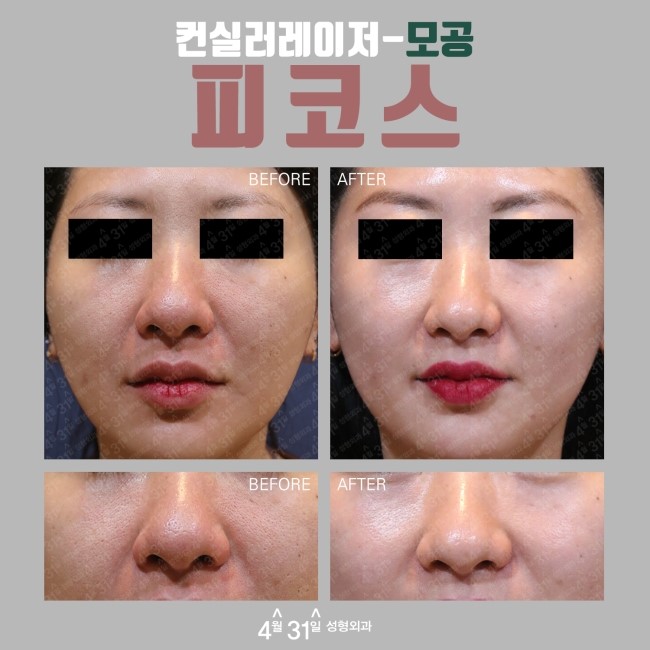 컨실러레이저 피코스레이저 모공축소레이저시술로 가능해 관련 이미지 3