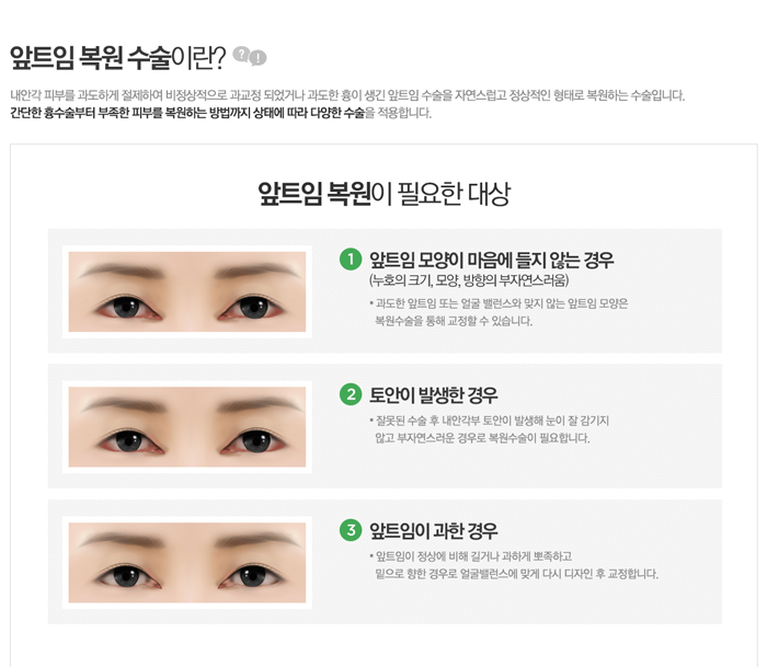 앞트임복원수술 4월31일성형외과라면 자연스럽게 관련 이미지 1