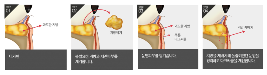하안검잘하는곳 찾고 있다면 4월31일성형외과의원 관련 이미지 3