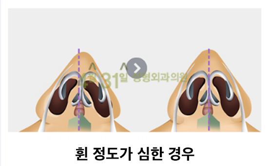 휜코교정잘하는곳 기능도 고려해야지 관련 이미지 4