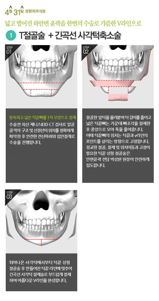 얼굴크기줄이기 4월31일성형외과의원에서 알려드려요 관련 이미지 2