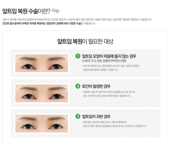 앞트임복원 4월31일성형외과에 맡기세요 관련 이미지 1