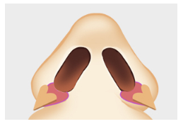 [Nose Surgery] Is It Possible to Reduce a Bulbous Nose with Alar Reduction? Yes or No? image 4