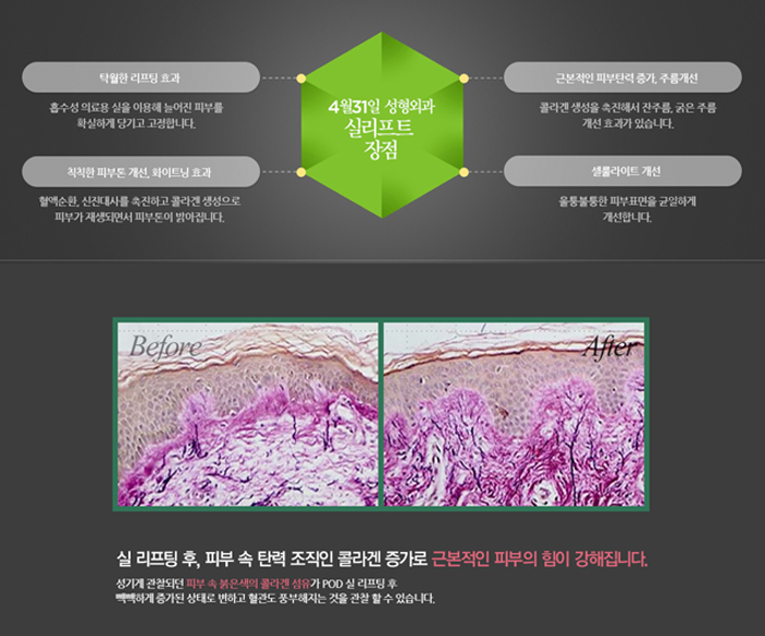 리프팅병원 4월31일성형외과의 88리프팅 관련 이미지 3