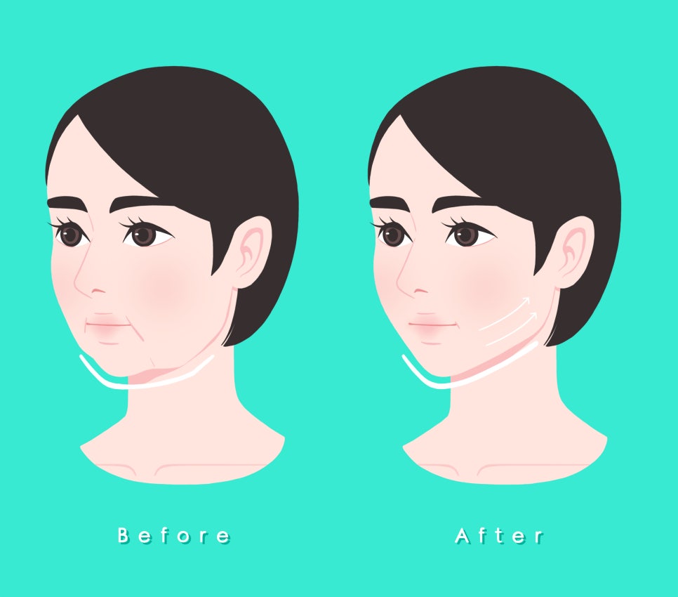 [April 31 Petit Center] What Causes a Square Jaw That Contour Injections Can’t Fix? (feat. Salivary Gland Botox) image 5