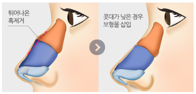 [코성형] 날카로운 인상을 세련되게 만들어주는 관련 이미지 4