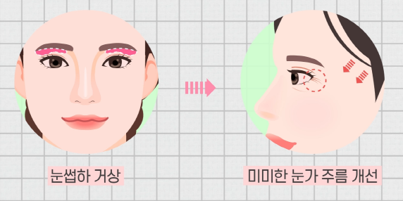 [Facelift Surgery] Endoscopic Forehead Lift or Brow Lift: Which Case Am I? image 9
