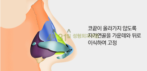 구축코재수술은 4월31일성형외과에서 관련 이미지 4