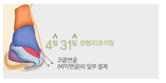 코성형잘하는곳 4월31일성형외과의원 긴코성형 알아봐요 관련 이미지 2