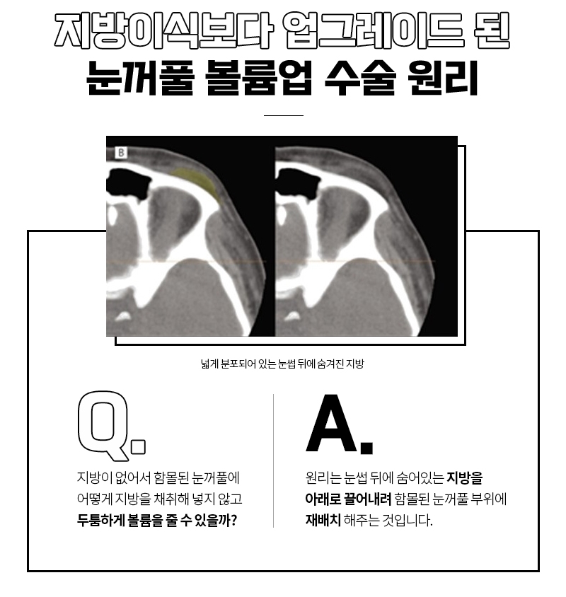 Fat Grafting for Sunken Upper Eyelids: Add Volume to Hollow Eyelids! image 3