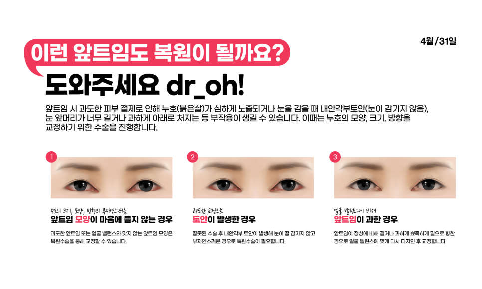 4월31일 Plastic Surgery Clinic: Wrong Epicanthoplasty or Canthoplasty? The Solution Is Right Here! image 4