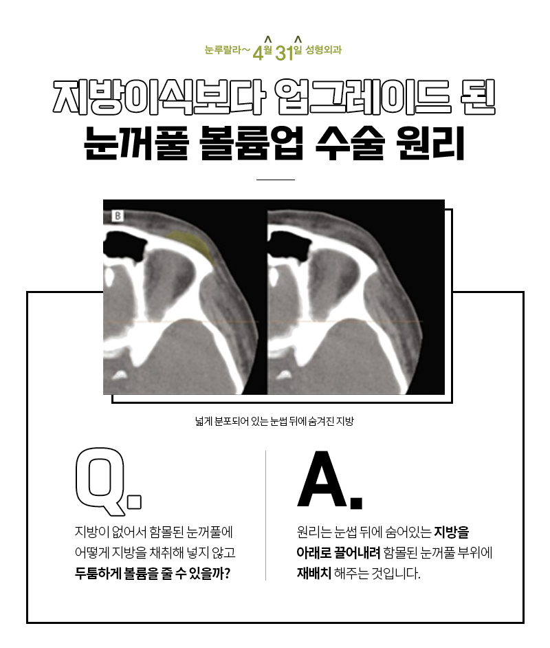 눈위꺼짐교정방법 오래가는 도톰한 볼륨을 원한다면? 관련 이미지 5