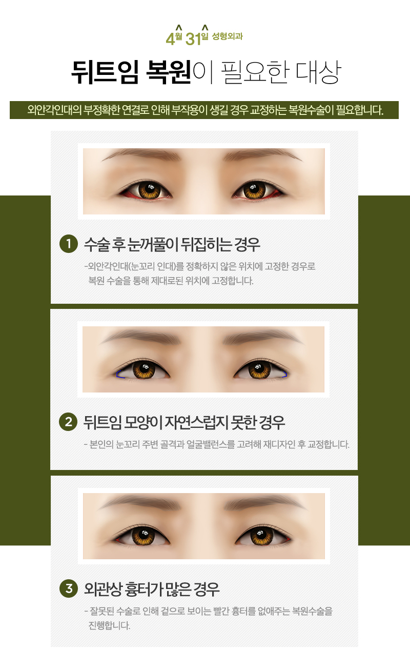 뒤트임복원비용 4월31일성형외과라면 충분! 관련 이미지 3