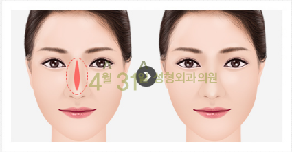 남자코재수술 4월31일성형외과의원에서 자연스럽게! 관련 이미지 4