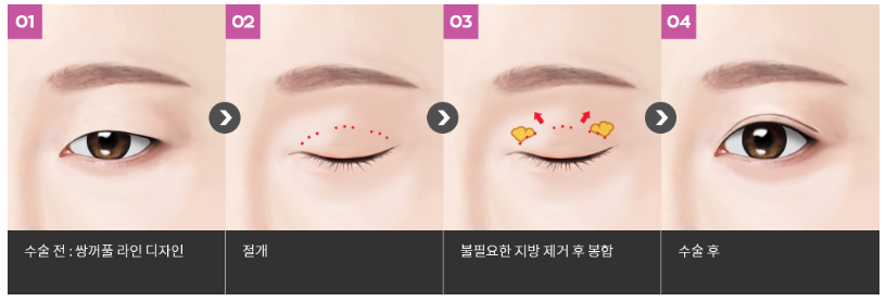 풀릴걱정 없는 4/31의 눈성형, 절개법 관련 이미지 4