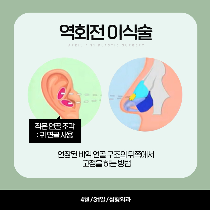 [구축코] 구축코 교정술 5단계 심층분석 Part03_이완시킨 연골 구조의 고정 관련 이미지 4