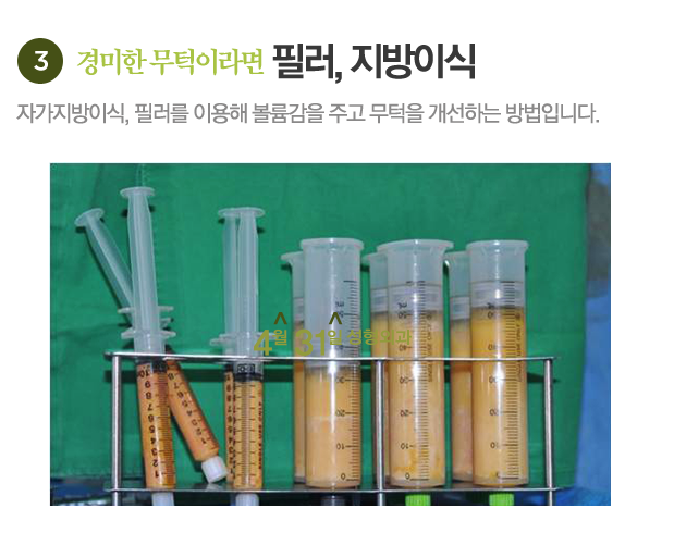 무턱수술잘하는곳 4월31일성형외과에서 알아보세요! 관련 이미지 6