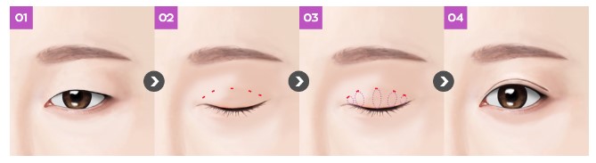 [Eye Plastic Surgery] Is male eye surgery always too feminine? Key points for male double eyelid surgery! image 4