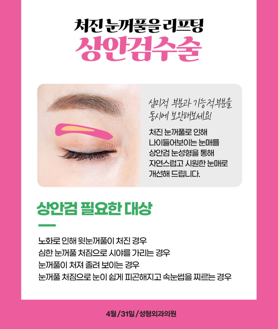 Recommended Middle-Aged Eye Surgery: Upper Blepharoplasty to Make Aging Eyes Look Youthful image 2