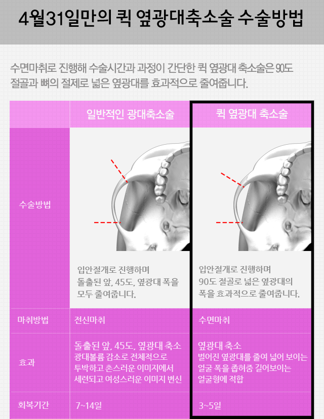 옆광대축소술 4월31일성형외과의 수면광대 관련 이미지 3