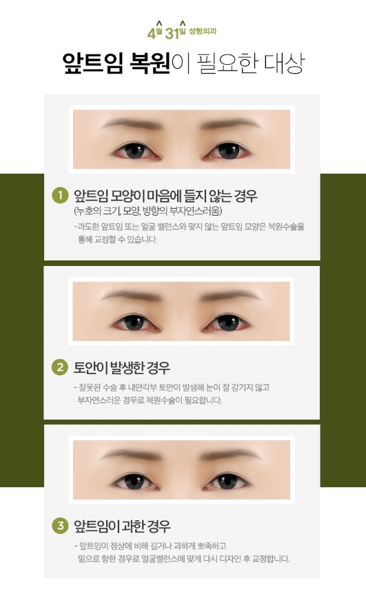 앞트임재수술잘하는곳 4월31일성형외과의 신중함 관련 이미지 2