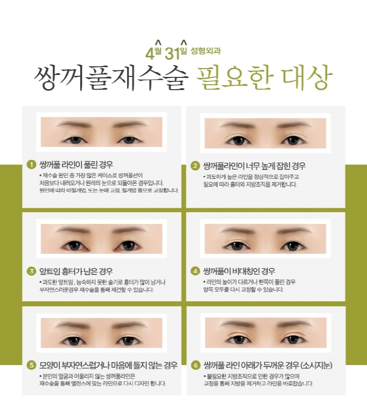 강남눈재수술병원 4월31일성형외과에서 고민해결 관련 이미지 3