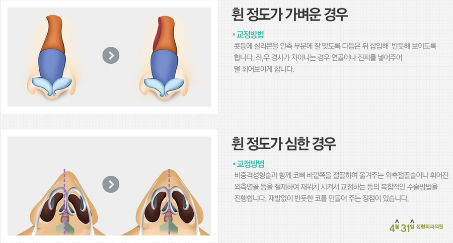 휜코성형수술 할때는 4월31일성형외과의원 관련 이미지 4