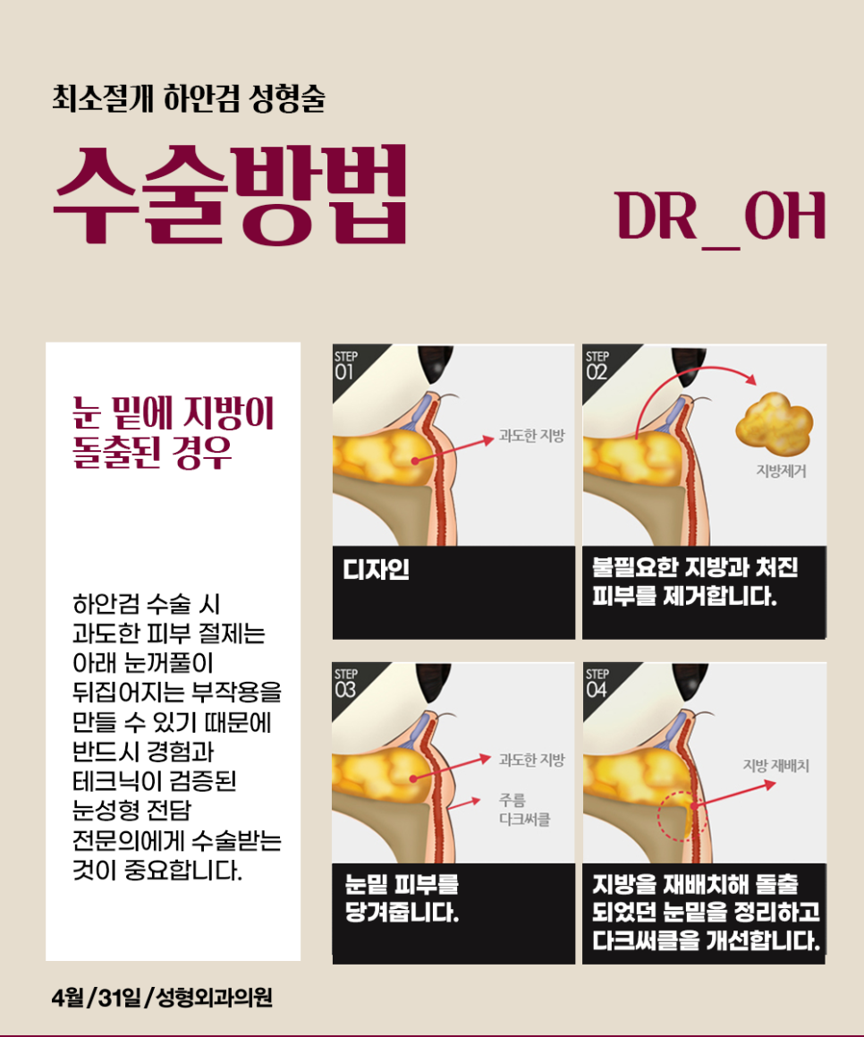 중년눈성형수술 이번 추석선물은 상안검, 하안검! 관련 이미지 3