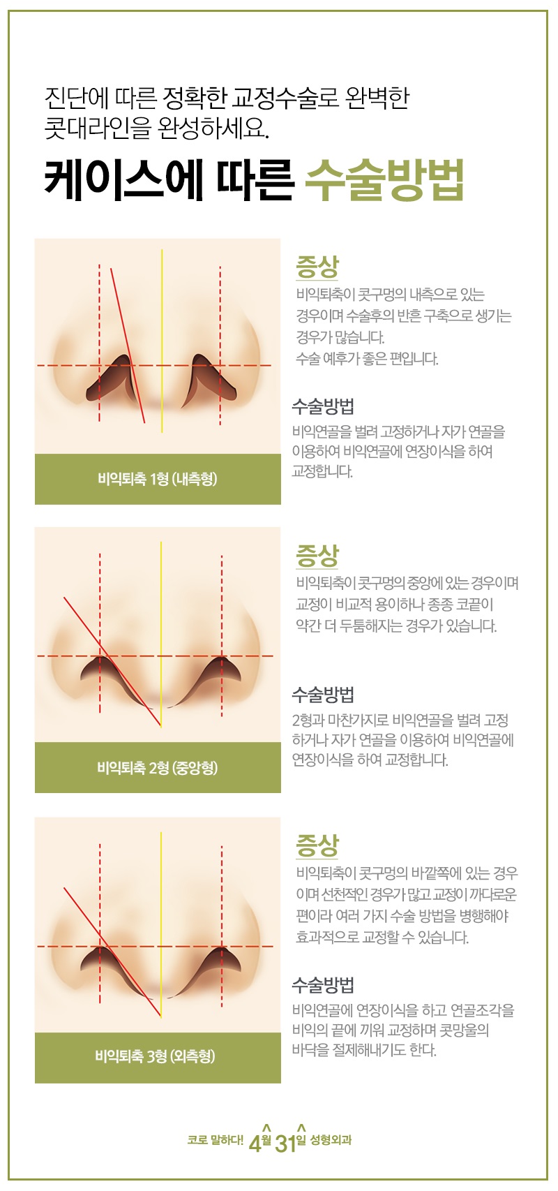 비공내리기 4월31일성형외과에서 극복! 관련 이미지 3