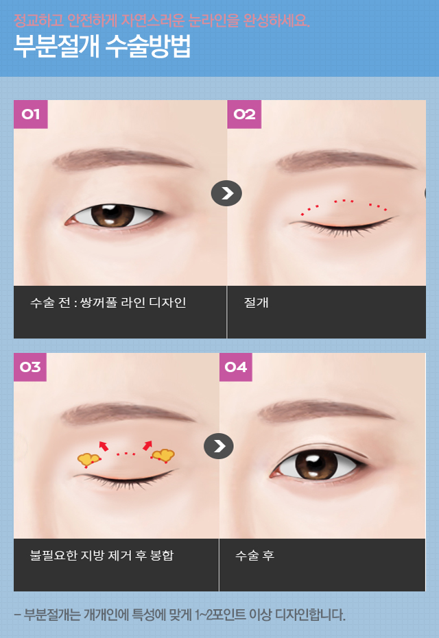 부분절개쌍꺼풀 4월31일성형외과에서 쉽게 관련 이미지 3