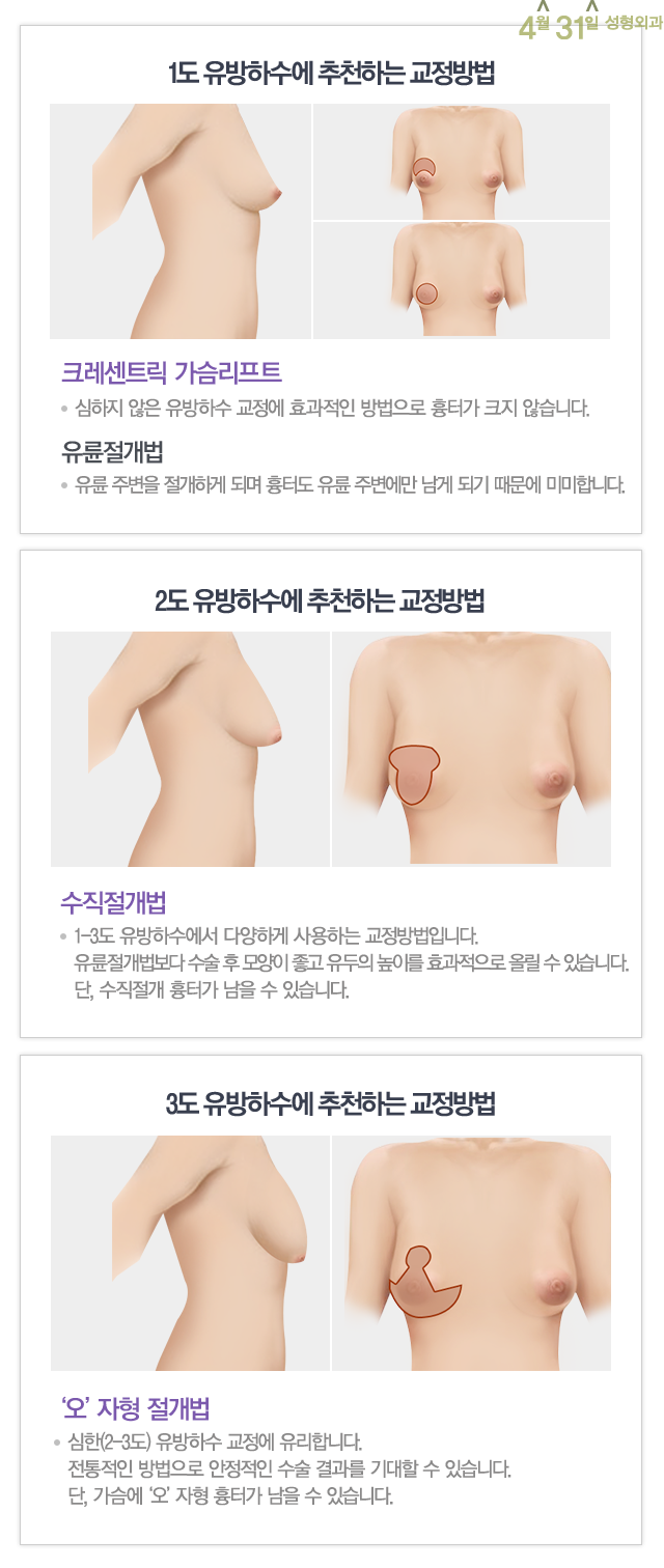 처진가슴성형잘하는곳 4월31일성형외과 관련 이미지 3