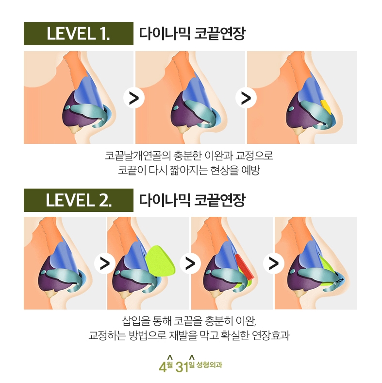 강남 들창코재수술 4월31일성형외과로! 관련 이미지 4
