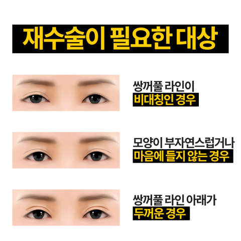 눈재수술잘하는병원 4월31일성형외과! 관련 이미지 4