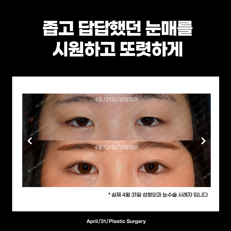 Quick Recovery, Natural-Looking Eyes? Instant Adhesion Double Eyelids image 6