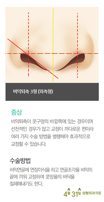 콧구멍수술 비익퇴축술 4월31일성형외과의원 관련 이미지 4