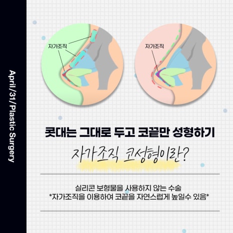 [Nose Surgery] Rhinoplasty Is Possible Without Implants image 3