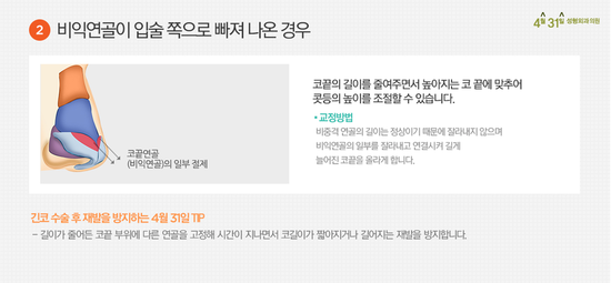 긴코수술 고민중이라면 4월31일성형외과의원 관련 이미지 3