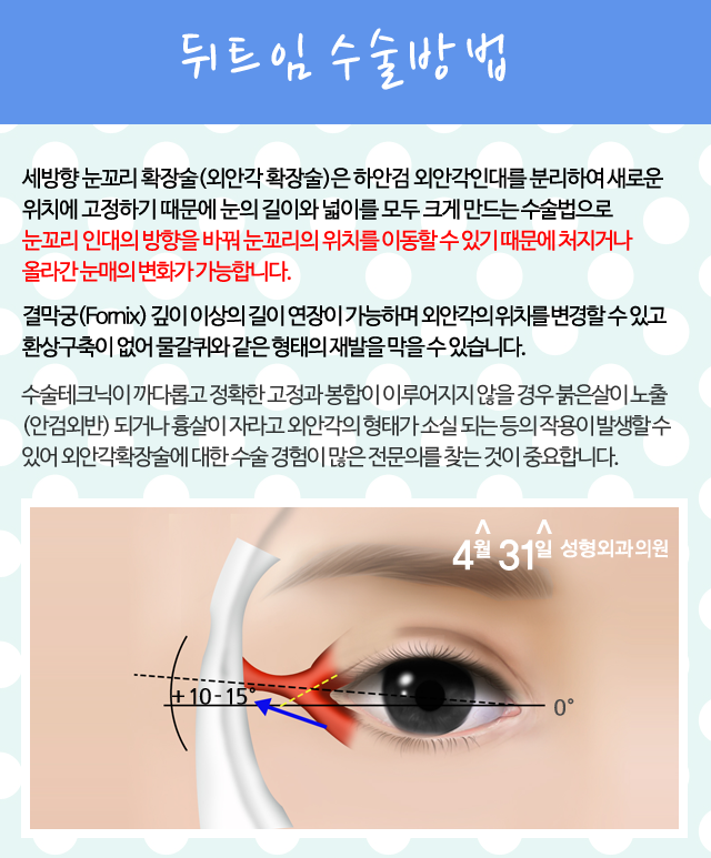 뒤트임수술 탁트인 눈매 4월31일성형외과 관련 이미지 3