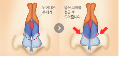 [코성형] 날카로운 인상을 세련되게 만들어주는 관련 이미지 6
