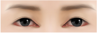[Eye Revision Surgery] A Difference Made by a Small Detail image 4