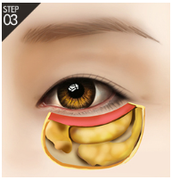 [De-Aging] Improve Under-Eye Sagging and Create a Youthful Eye Area with Aegyosal - Soup Lift image 5