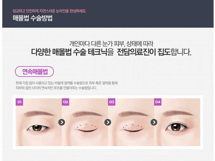 쌍꺼풀 매몰법 4월31일성형외과의 차별화 관련 이미지 5
