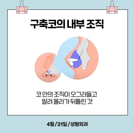 [Contracted Nose] Deep Analysis of the 5-Step Contracted Nose Correction Surgery Part 01_ Sufficient Dissection and Release image 3
