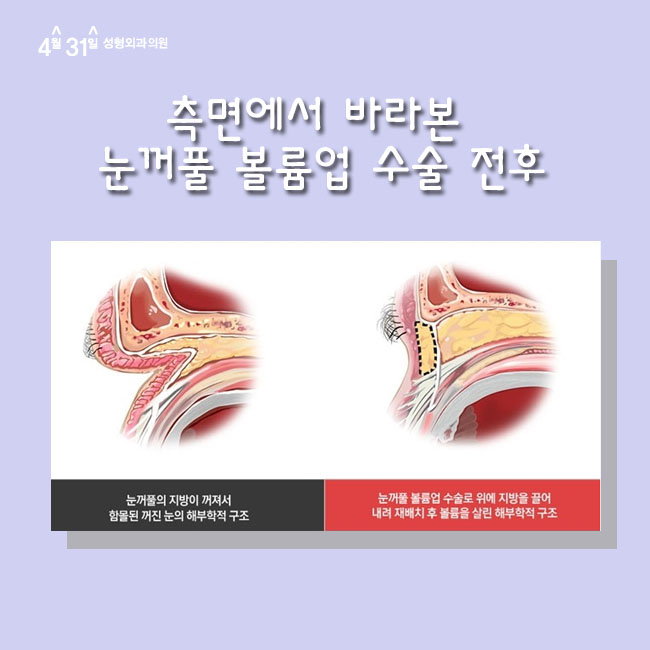 꺼진눈성형 볼륨있는 동안눈매 관련 이미지 3