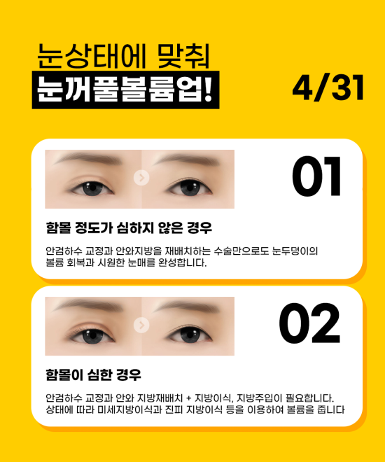 눈위꺼짐 고민! 지방이식보다 업그레이드! 눈꺼풀볼륨업 관련 이미지 3