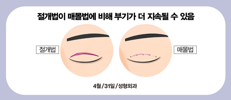 [Eye Surgery] Swelling and Scarring After Double Eyelid Surgery image 3