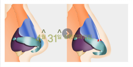 코끝성형 들리지 않게 4월31일성형외과의원 관련 이미지 3
