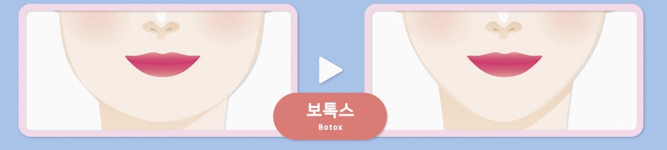 Make an Oval, V-Line Face with Chin Filler + Chin Botox! image 5