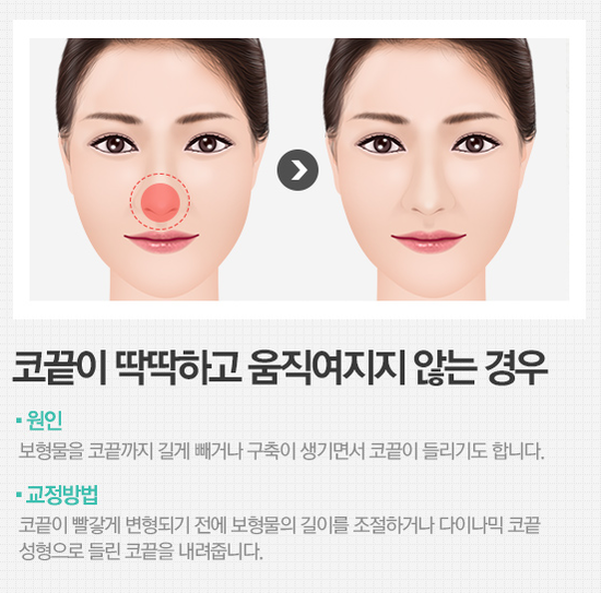 들린코재수술 이번이 마지막 4월31일성형외과의원 관련 이미지 2