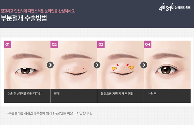 강남쌍꺼풀잘하는곳 4월31일성형외과의원 부분절개 관련 이미지 2